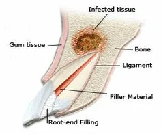 Root Tip Removal