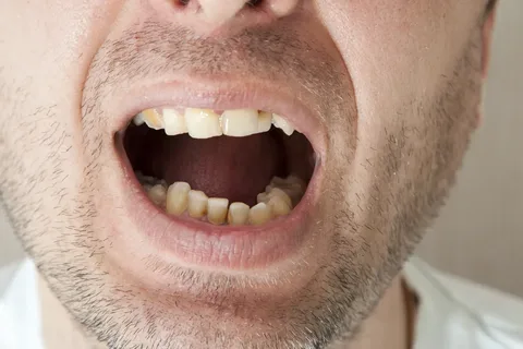 Preserves the Natural Tooth
