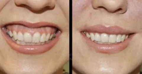 Repairs Receding Gums