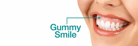 Enhances Smile Aesthetics