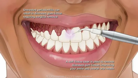 Treats Advanced Gum Disease